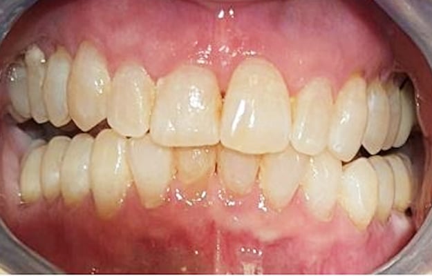 Clear Aligner After Photo