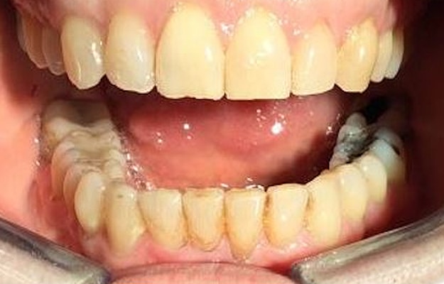Clear Aligner After Photo