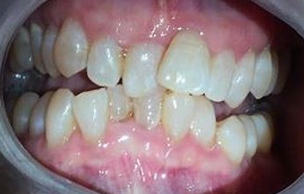 Clear Aligner Before Photo