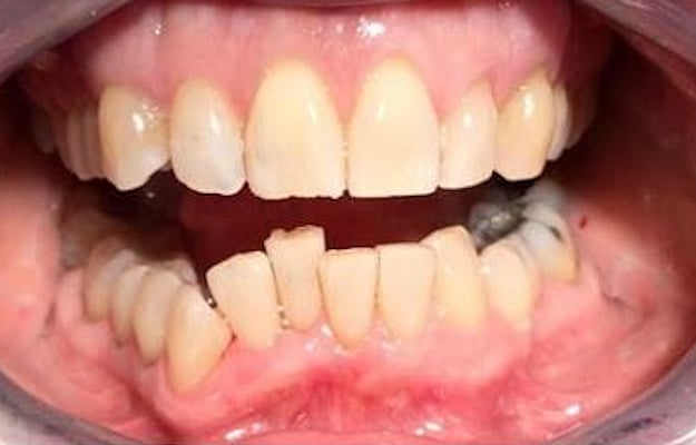 Clear Aligner Before Photo