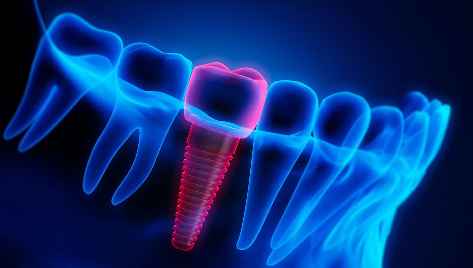 Dental Implant Benefits Graphic