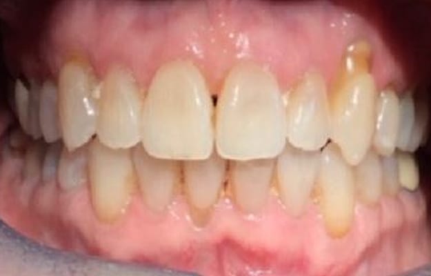 Clear Aligner After Photo