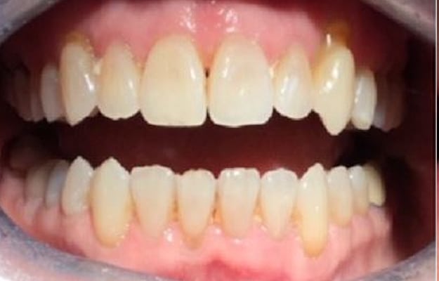 Clear Aligner After Photo