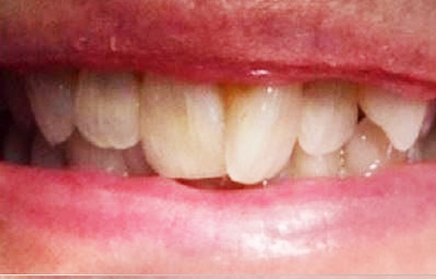 Clear Aligner Before Photo