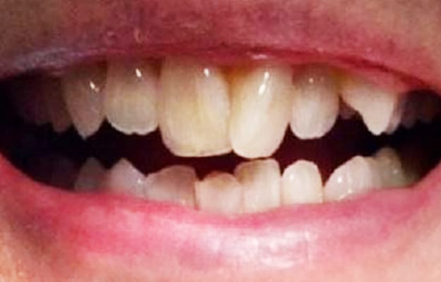 Clear Aligner Before Photo